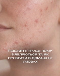 Підшкірні прищі: чому з'являються і як прибрати в домашніх умовах