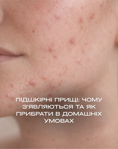 Підшкірні прищі: чому з'являються і як прибрати в домашніх умовах