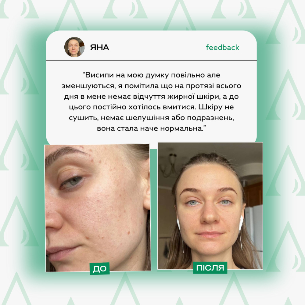 Сироватка для обличчя з проявами акне  від Lamic "Siero per il viso con sintomi di acne", 50ml