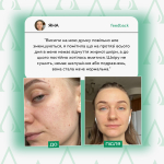 Сироватка для обличчя з проявами акне  від Lamic "Siero per il viso con sintomi di acne", 50ml